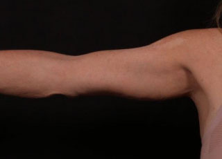 After Image: Brachioplasty (Arm Lift) - front