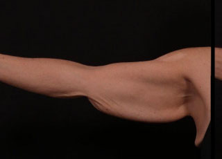 Before Image: Brachioplasty (Arm Lift) - front