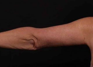 After Image: Brachioplasty (Arm Lift) - back