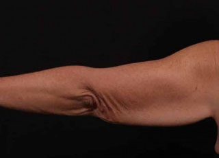 Before Image: Brachioplasty (Arm Lift) - back