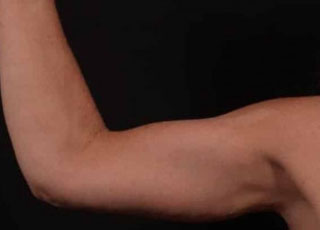 After Image: Brachioplasty (Arm Lift) - front