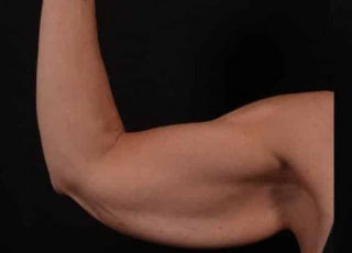 Before Image: Brachioplasty (Arm Lift) - front