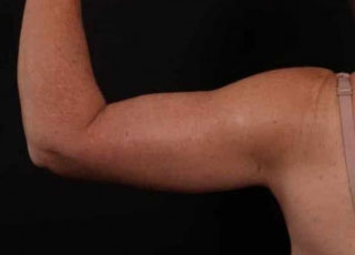 After Image: Brachioplasty (Arm Lift) - back