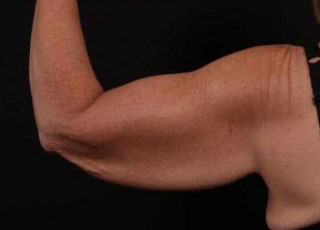 Before Image: Brachioplasty (Arm Lift) - back