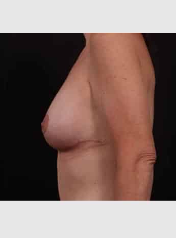 After Image: Breast Lift (Mastopexy) with Augmentation - left-side
