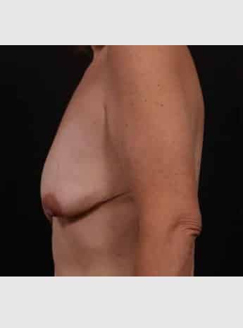 Before Image: Breast Lift (Mastopexy) with Augmentation - left-side