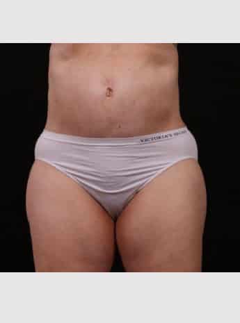 After Image: Tummy Tuck (Abdominoplasty) - front