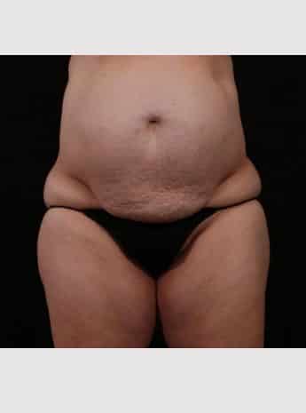 Before Image: Tummy Tuck (Abdominoplasty) - front