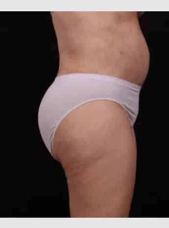 After Image: Tummy Tuck (Abdominoplasty) - right-side