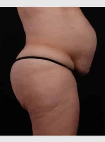 Before Image: Tummy Tuck (Abdominoplasty) - right-side