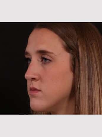 After Image: Rhinoplasty - left-front-oblique