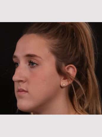 Before Image: Rhinoplasty - left-front-oblique
