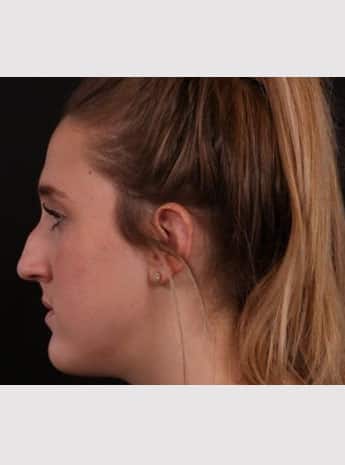Before Image: Rhinoplasty - left-side