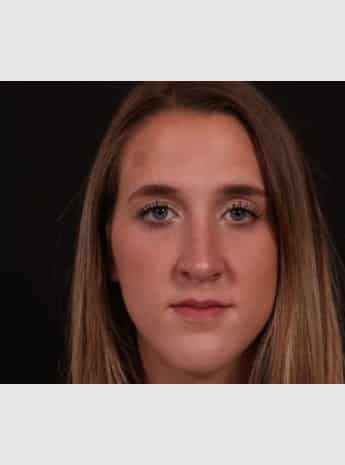 After Image: Rhinoplasty - front