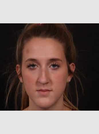 Before Image: Rhinoplasty - front