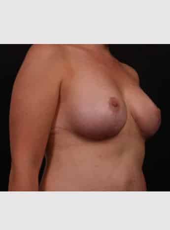 After Image: Mastopexy (Breast Lift) - right-front-oblique