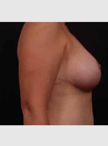 After Image: Mastopexy (Breast Lift) - right-side