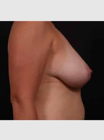 Before Image: Mastopexy (Breast Lift) - right-side