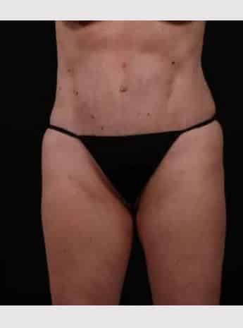 After Image: Tummy Tuck (Abdominoplasty) - front
