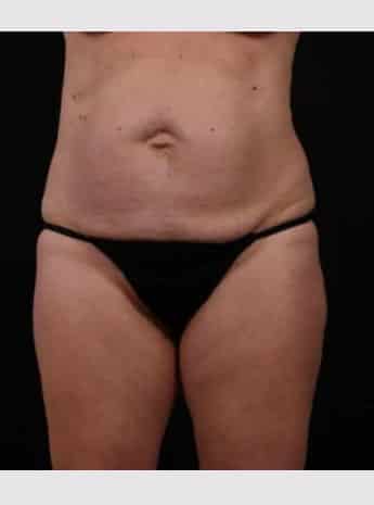 Before Image: Tummy Tuck (Abdominoplasty) - front