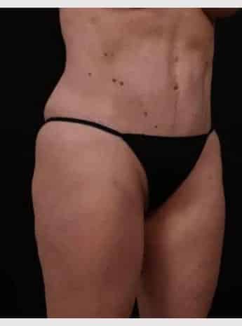 After Image: Tummy Tuck (Abdominoplasty) - right-front-oblique