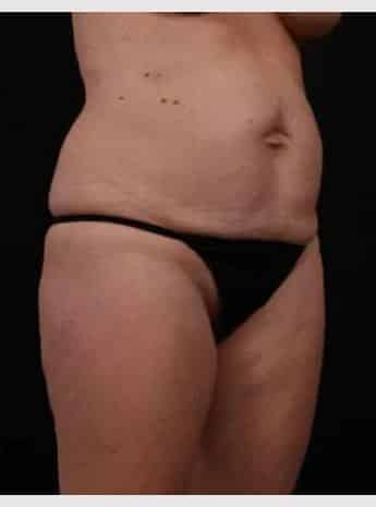 Before Image: Tummy Tuck (Abdominoplasty) - right-front-oblique
