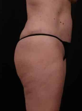 After Image: Tummy Tuck (Abdominoplasty) - right-side