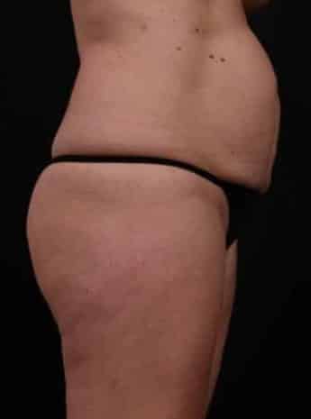 Before Image: Tummy Tuck (Abdominoplasty) - right-side