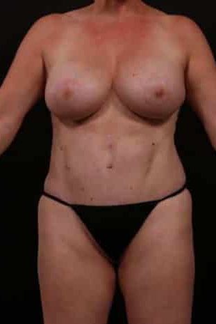 After Image: Mommy Makeover - front