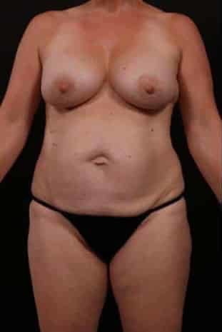 Before Image: Mommy Makeover - front