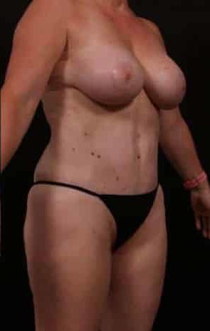 After Image: Mommy Makeover - right-front-oblique