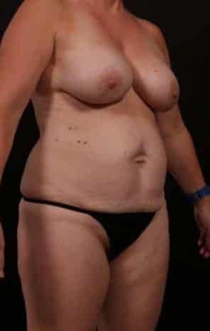 Before Image: Mommy Makeover - right-front-oblique