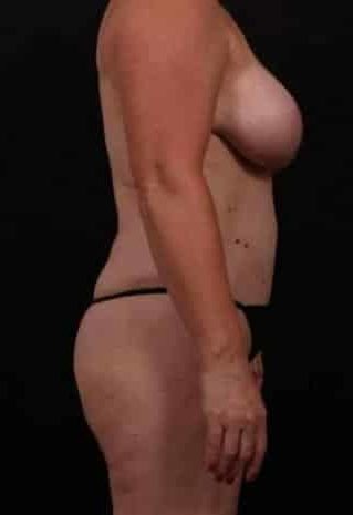After Image: Mommy Makeover - right-side