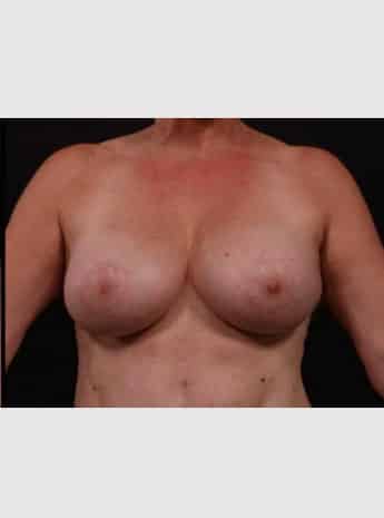 After Image: Secondary Breast Surgery - front