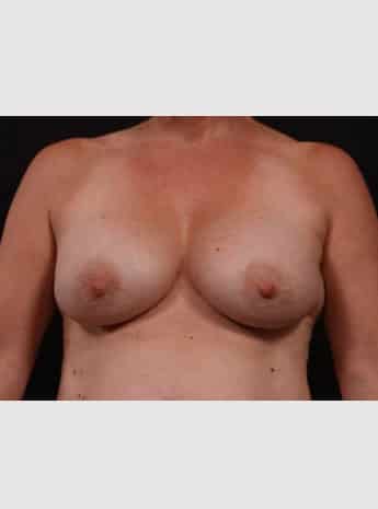 Before Image: Secondary Breast Surgery - front