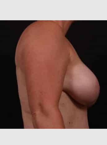 After Image: Secondary Breast Surgery - right-side
