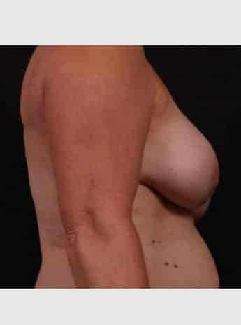 Before Image: Secondary Breast Surgery - right-side