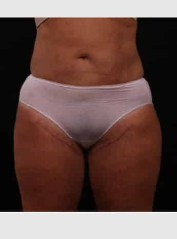 After Image: Liposuction with Abdominal Skin Excision - front