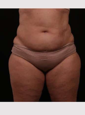 Liposuction with Abdominal Skin Excision