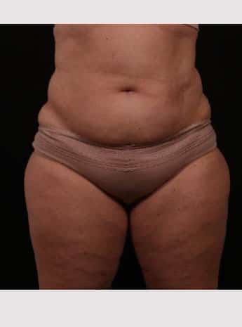 Before Image: Liposuction with Abdominal Skin Excision - front