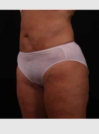 After Image: Liposuction with Abdominal Skin Excision - left-front-oblique