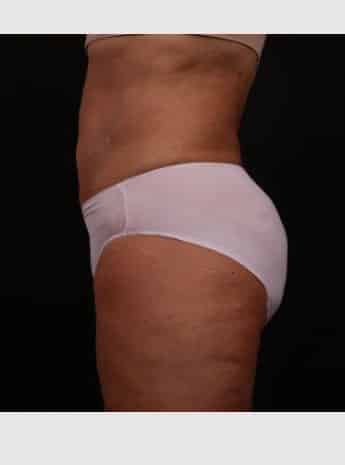 After Image: Liposuction with Abdominal Skin Excision - left-side