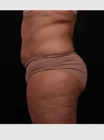 Before Image: Liposuction with Abdominal Skin Excision - left-side