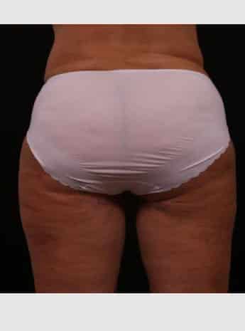 After Image: Liposuction with Abdominal Skin Excision - back