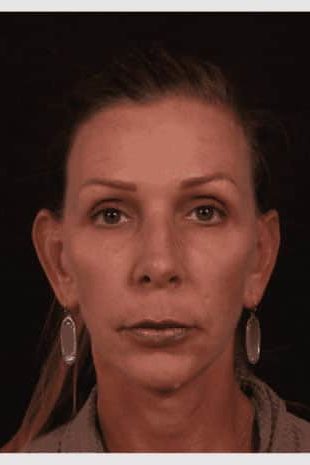 After Image: Neck Lift / Lower Facelift - front
