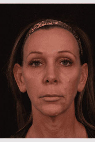 Before Image: Neck Lift / Lower Facelift - front