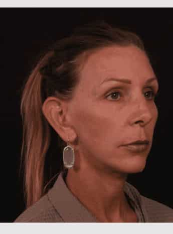 After Image: Neck Lift / Lower Facelift - right-front-oblique