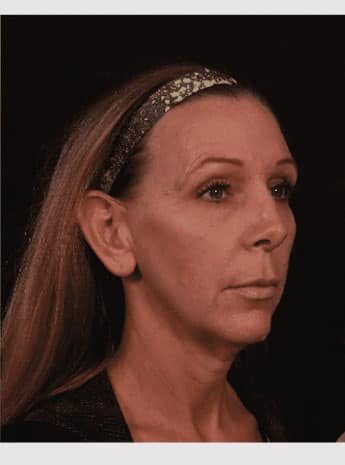 Before Image: Neck Lift / Lower Facelift - right-front-oblique