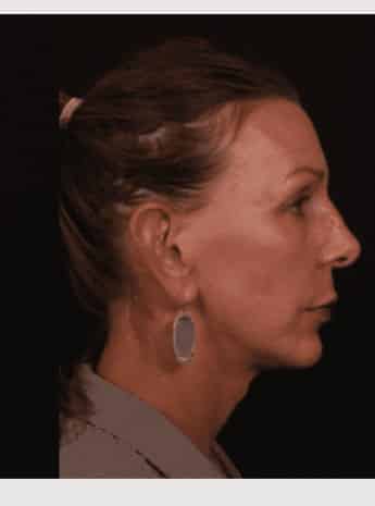 After Image: Neck Lift / Lower Facelift - right-side