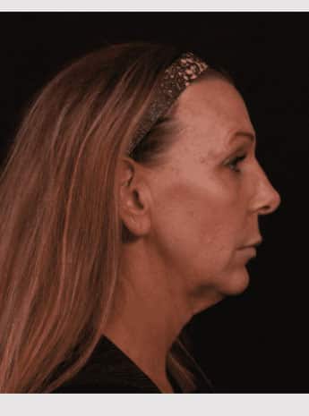 Before Image: Neck Lift / Lower Facelift - right-side